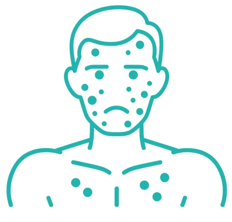 Acne-prone skin
