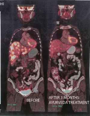 After Treatment