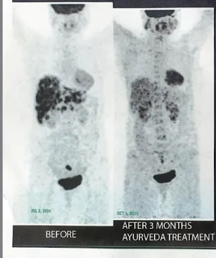 Before Treatment