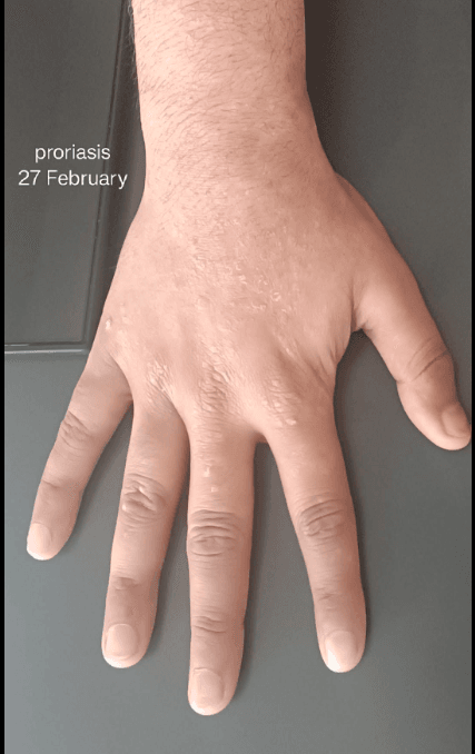 After Treatment