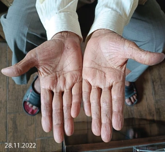 After Treatment