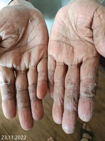 Before Treatment